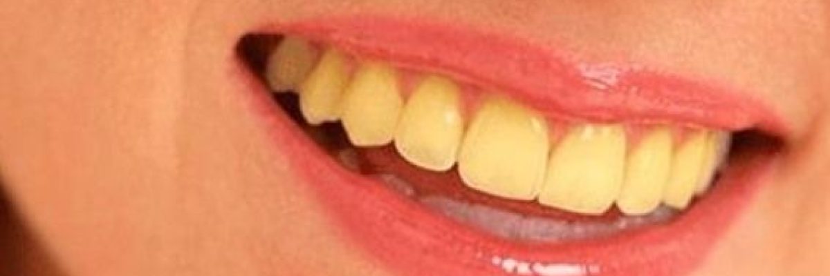 10-اسباب-لاصفرار-الاسنان
