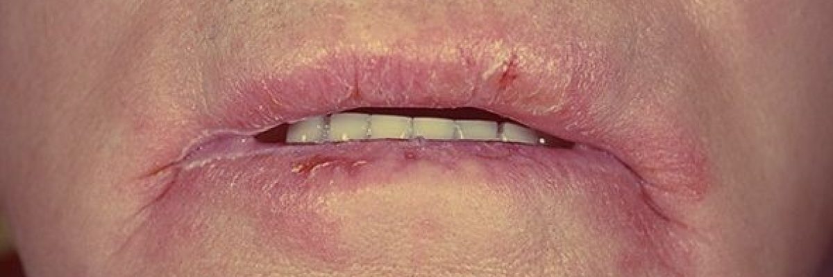 اطباء-يحذرون_-تشقق-زوايا-الفم-قد-ينجم-عن-اسباب-خطيرة