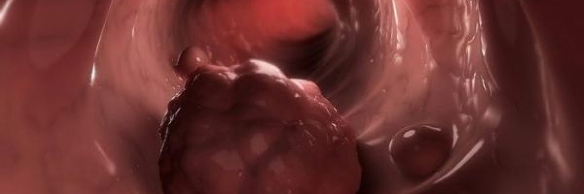اكتشاف-الخلايا-المسؤولة-عن-انتكاس-مرضى-سرطان-القولون