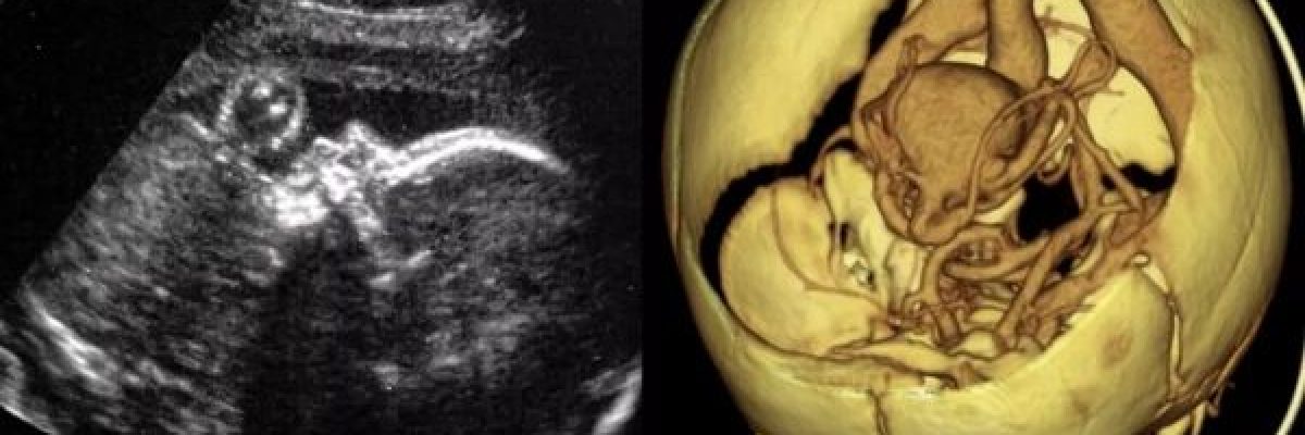 الاولى-بالعالم.-اطباء-يجرون-جراحة-لدماغ-جنين-في-رحم-امه