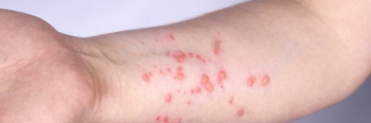 الصين-ترصد-سلالة-فرعية-متحورة-جديدة-من-جدري-القرود الصين-ترصد-سلالة-فرعية-متحورة-جديدة-من-جدري-القرود