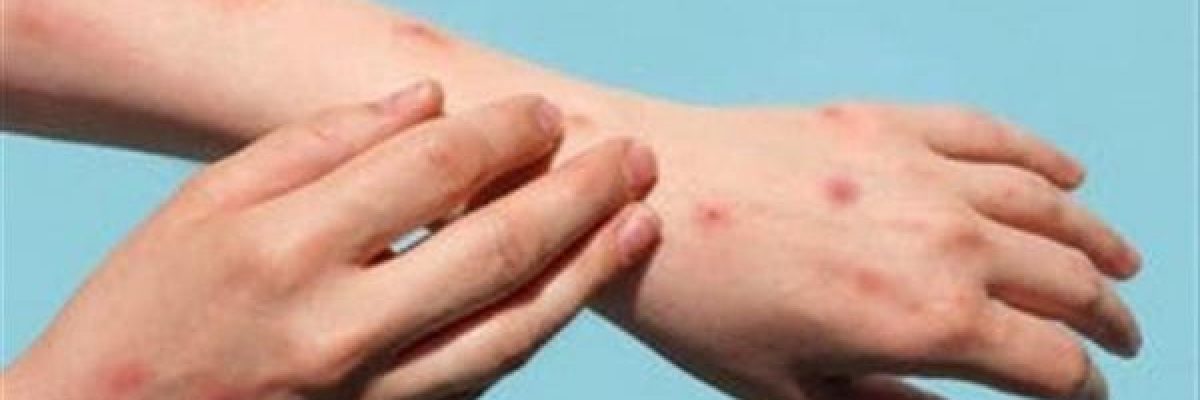 اليونيسيف-تطرح-مناقصة-طارئة-لتامين-لقاحات-جدري-القردة