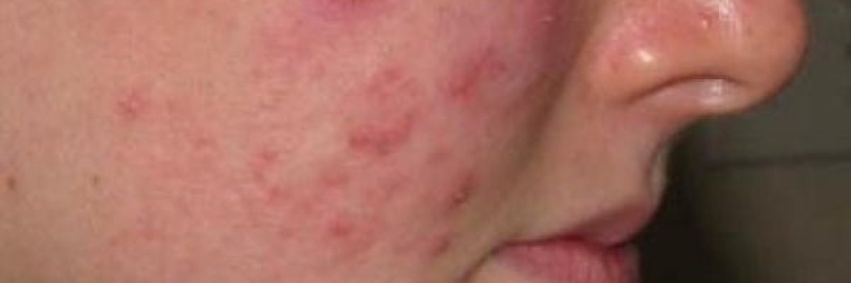 تعرف-على-5-علاجات-منزلية-للدمامل-الناتجة-عن-الحرارة