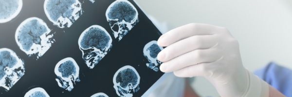 تعرف-على-7-اشياء-تزيد-من-خطورة-الاصابة-بالسكتة-الدماغية