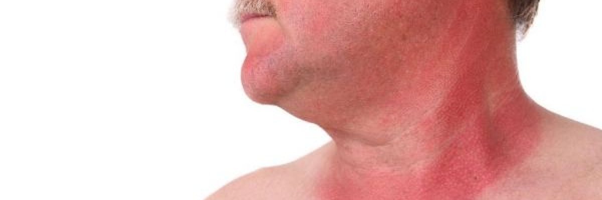 تعرف-على-8-حلول-منزلية-بسيطة-لحروق-الشمس