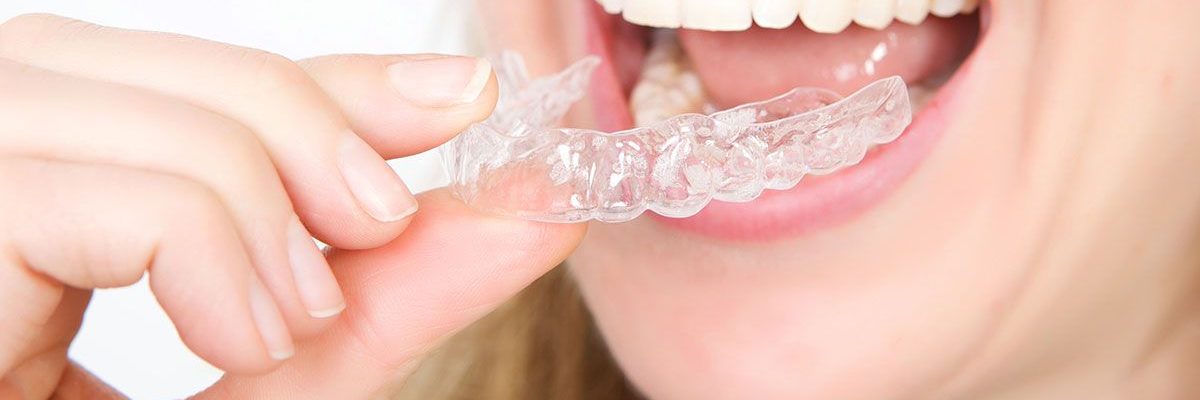 تعرف-على-احدث-تقنيات-تقويم-الاسنان.-القالب-الشفاف