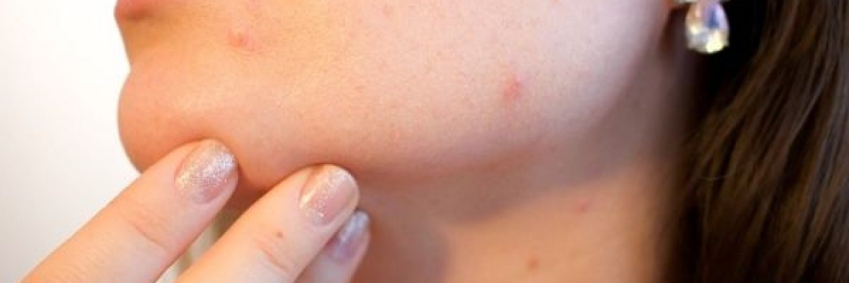 تعرف-على-خطوات-يومية-للقضاء-على-حب-الشباب