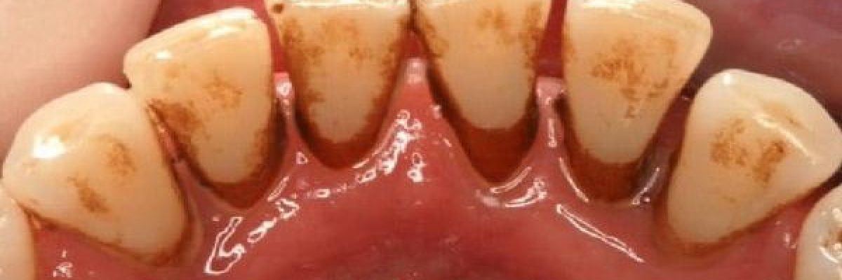 تعرف-على-طرق-طبيعة-لازالة-جير-الاسنان