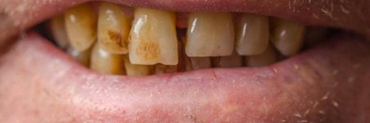 تعرف-كيف-تحمي-اسنانك-من-_الاصفرار_؟