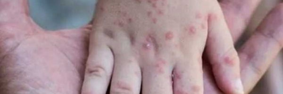 ثلاث-اصابات-جديدة-بجدري-القرود-في-كوريا-الجنوبية