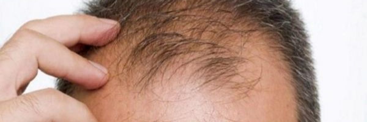 خبراء-يكشفون-5-اسباب-_مفاجئة_-تجعل-الشعر-يتساقط