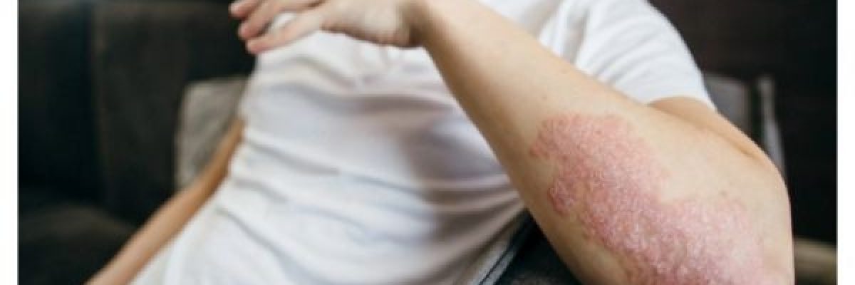 دراسة-تربط-الاطعمة-فائقة-المعالجة-بمرض-الصدفية