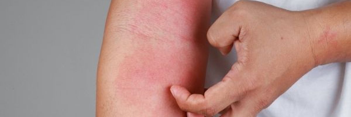 دراسة_-التوتر-والضغط-النفسي-يزيدان-من-حساسية-الجلد دراسة_-التوتر-والضغط-النفسي-يزيدان-من-حساسية-الجلد