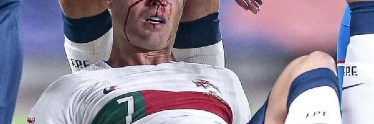 رونالدو-يتعرض-لاصابة-شديدة-خلال-مباراة-البرتغال-والتشيك