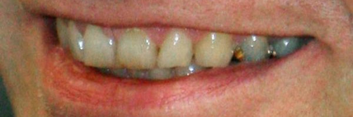 ستة-اسباب-غير-مالوفة-لاصفرار-الاسنان