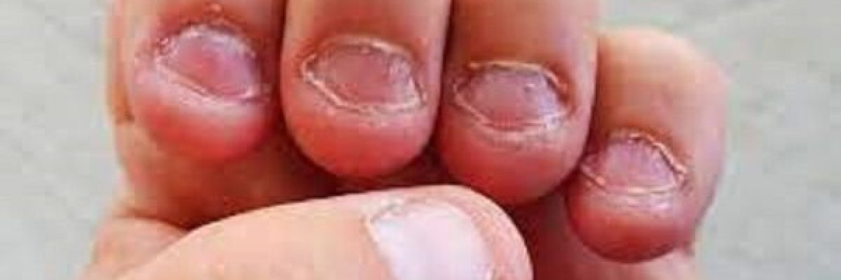 طبيبة-تكشف-اسباب-قضم-الاظافر