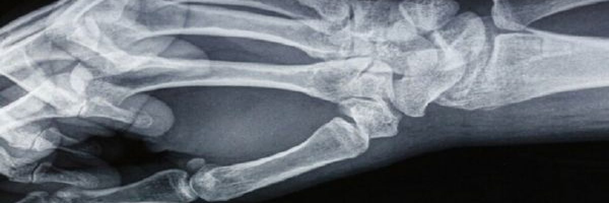 عشر-نصائح-طبية-للتعامل-مع-اصابات-كسور-العظام