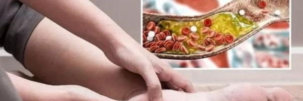 علامة-في-القدمين-قد-تشير-الى-ارتفاع-نسبة-الكوليسترول-بالدم