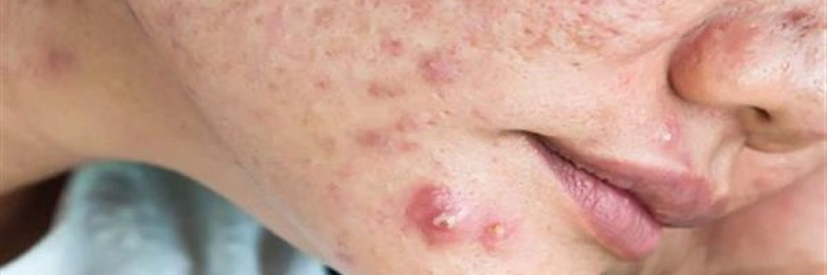 علماء-يطورون-لقاحا-ضد-حب-الشباب