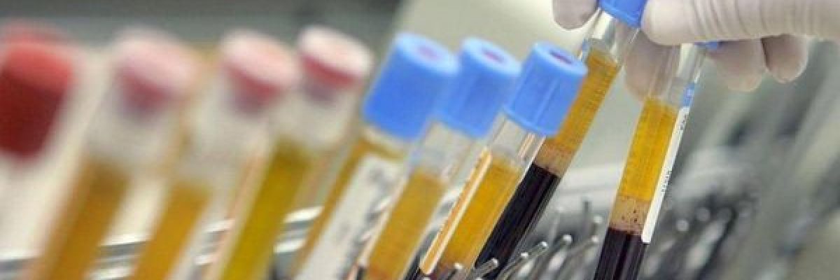 علماء-يقولون-انهم-اقتربوا-من-التوصل-لتحليل-دم-للارهاق-المزمن