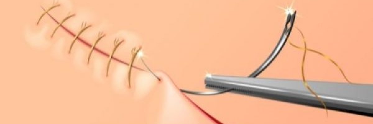 علماء-ينجحون-في-صناعة-خيوط-استثنائية-لخياطة-الجروح