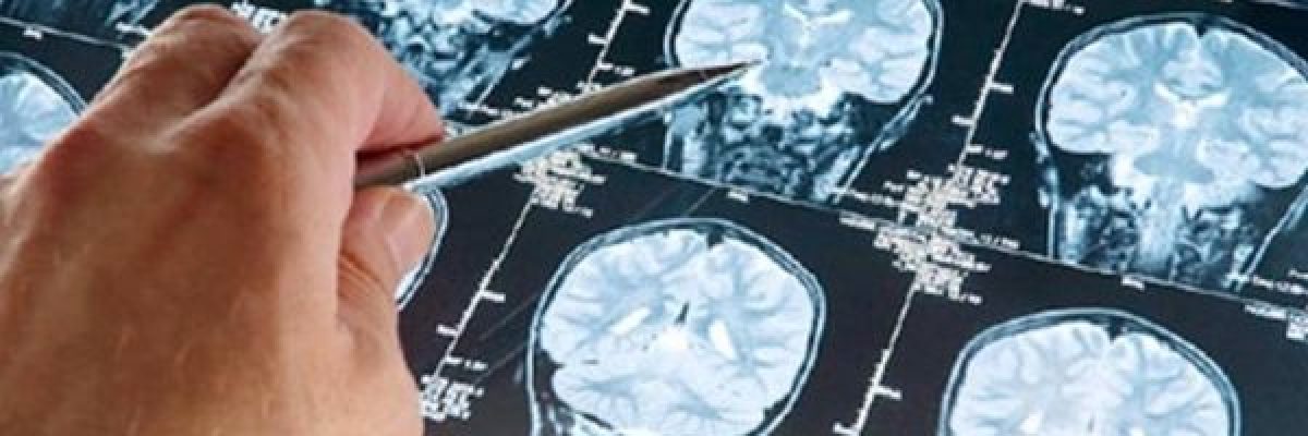 علماء_-دائرتان-في-المخ-مصدر-الافكار-الانتحارية-للانسان