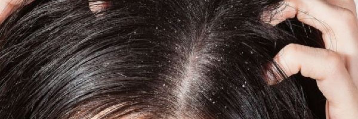 كيف-تتخلص-من-_قشرة-الراس_-بطرق-طبيعية-وسهلة؟