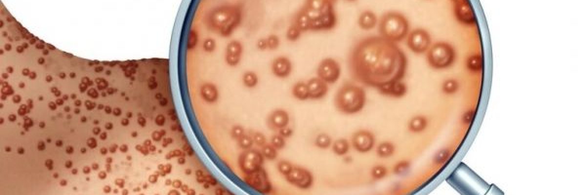 لا-يوجد-سبب-للخوف-منه.-كل-ما-تريد-معرفته-حول-جدري-القردة-