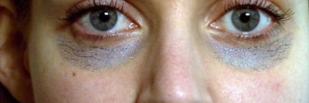 لماذا-تنشا-الهالات-السوداء-تحت-العينيين-وما-علاجها؟