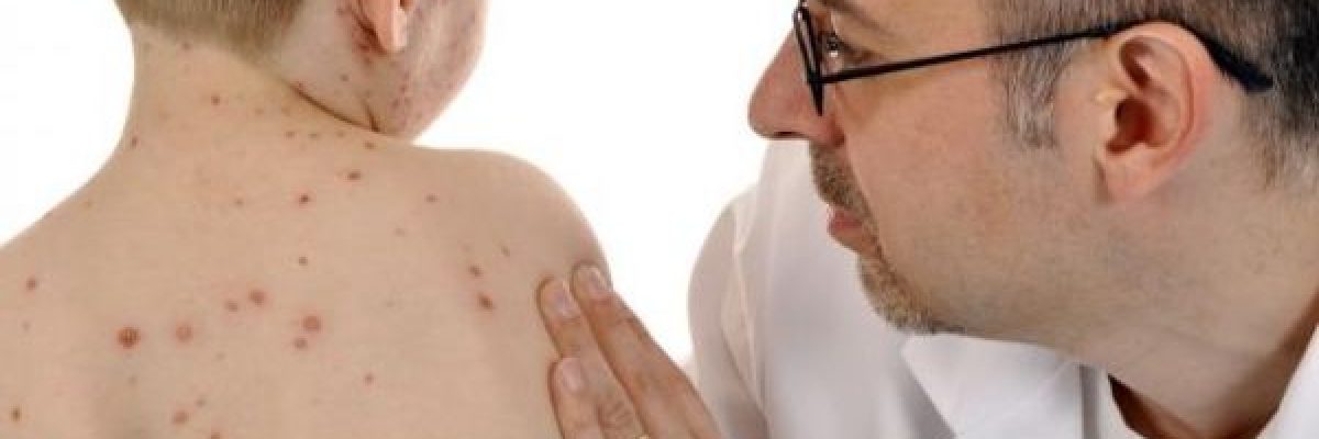 ما-اعراض-الحصبة-لدى-الاطفال؟
