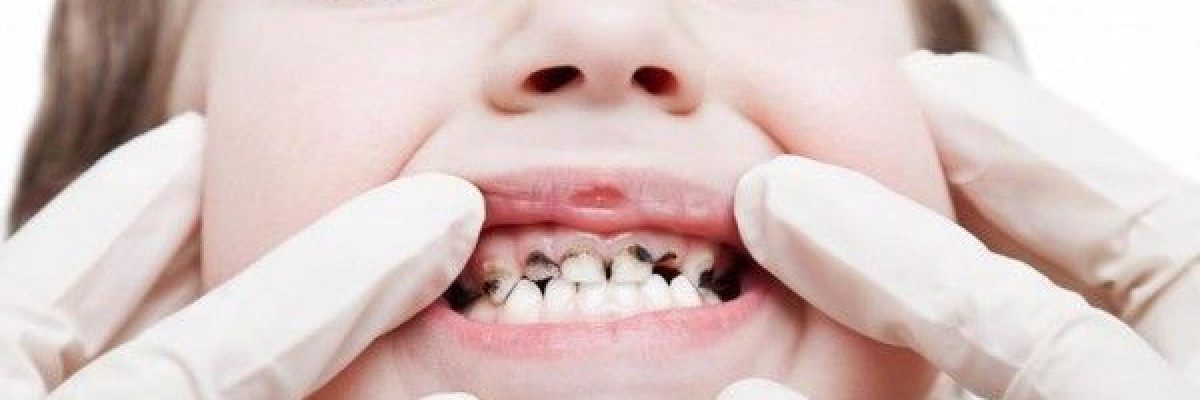 ما-مرض-الاسنان-الطباشيرية؟